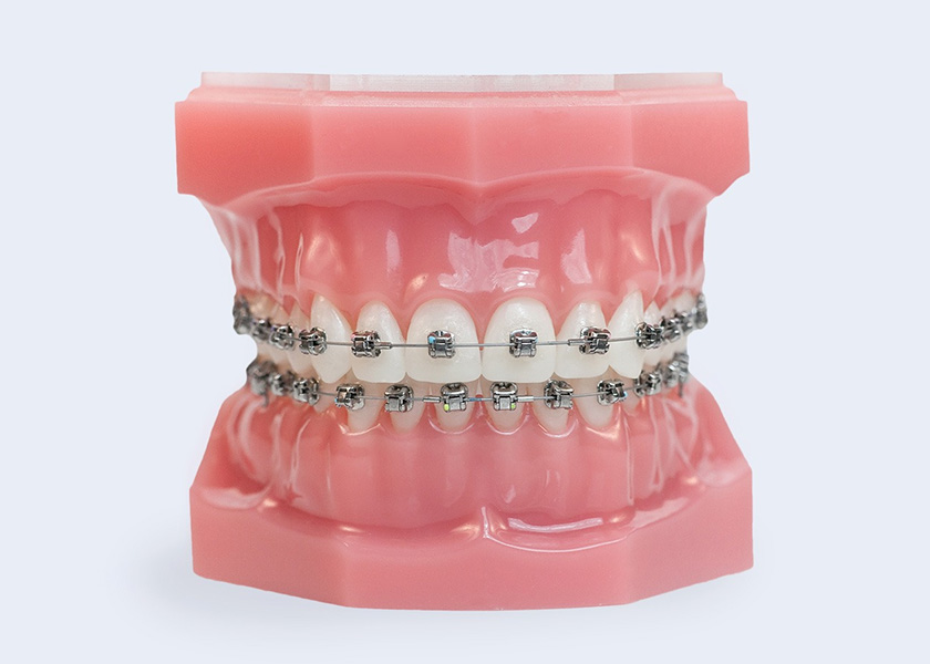 img-Braces in Monrovia, CA