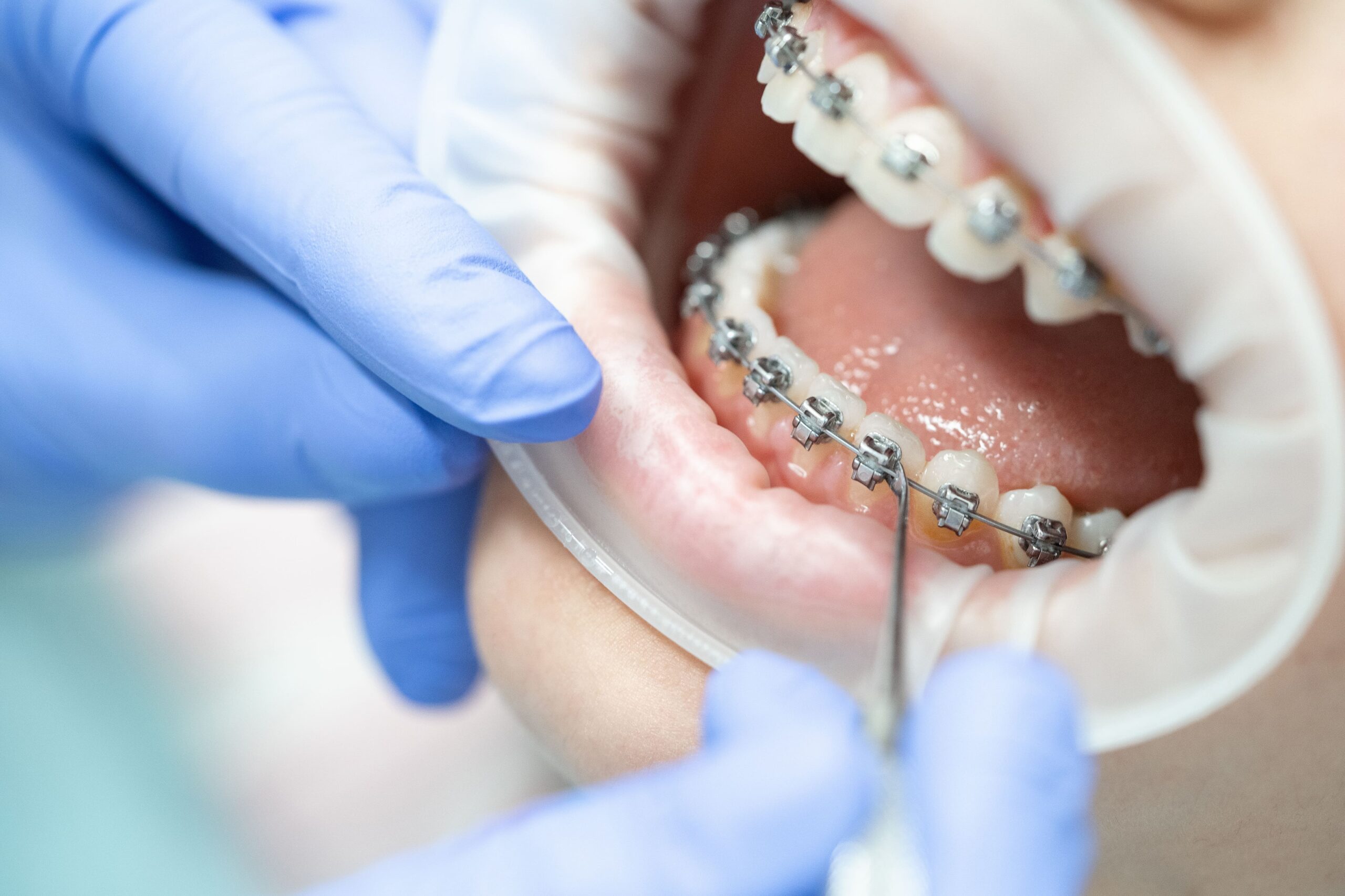 braces orthodontist in Monrovia CA