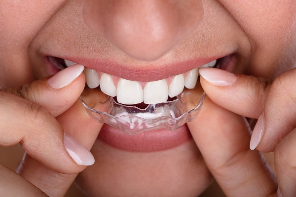What Can I Expect When I Get Clear Aligners? [Ask An Orthodontist]