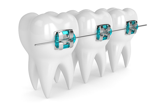 How An Orthodontist Fixes Crowded Teeth With Braces